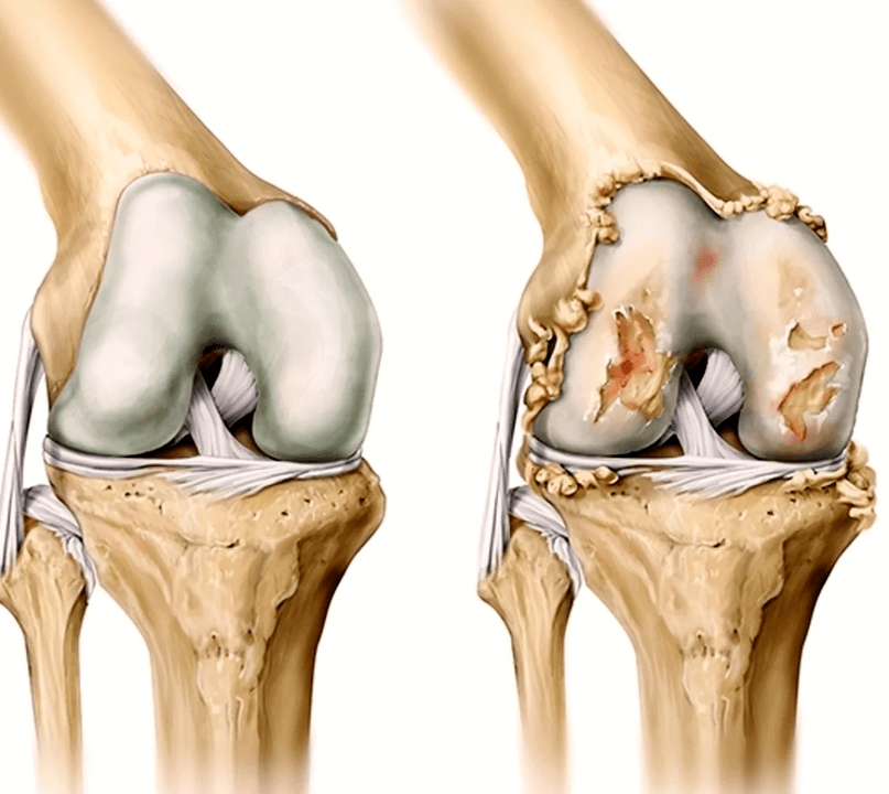 Diseased and healthy joints after using Artovitel Gel