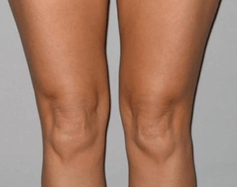 I healed my knee joint with Artovitel gel