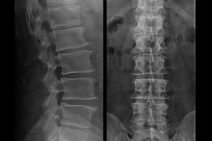 X-ray shows osteochondrosis