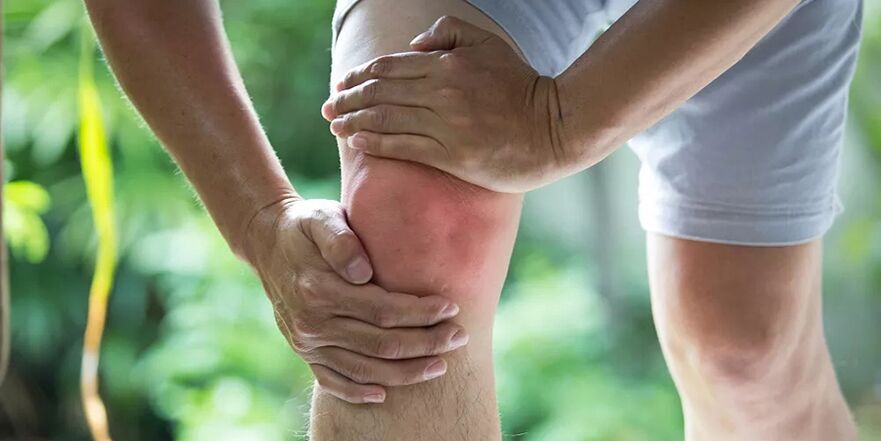 Arthritis of the knee causing severe pain during physical activity